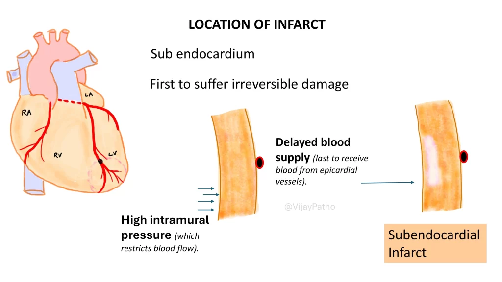 subendocardial infarct: myocardial infarction