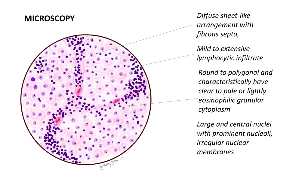 Seminoma microscopy