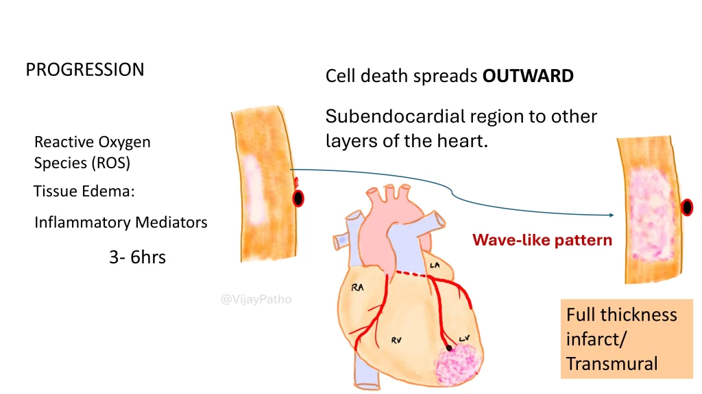 transmural  infarct: myocardial infarction