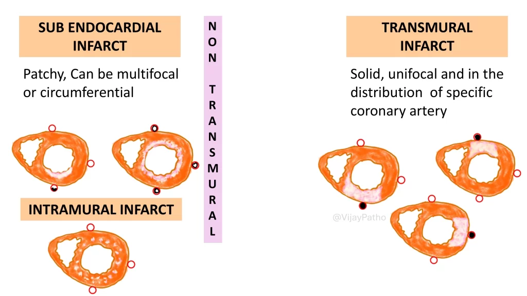 subendocardial vs transmural  infarct: myocardial infarction