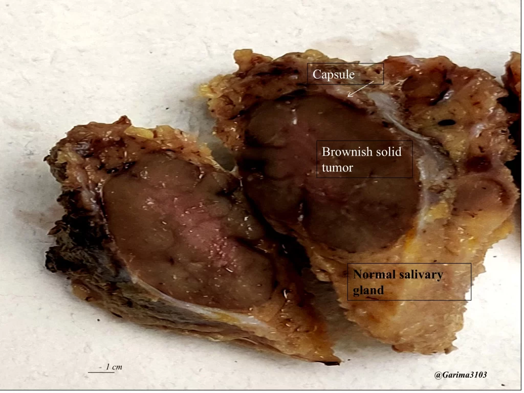 Oncocytoma gross