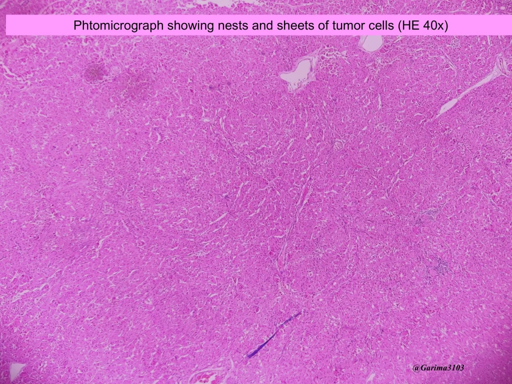 Microscopy of oncocytoma