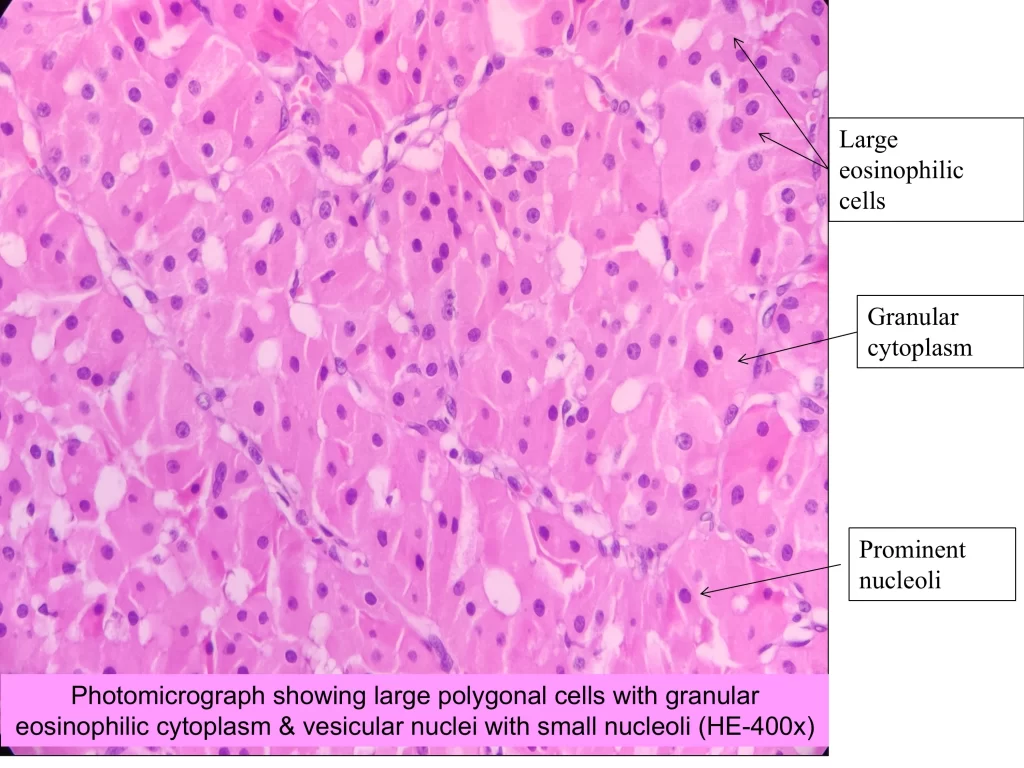 Microscopy of oncocytoma