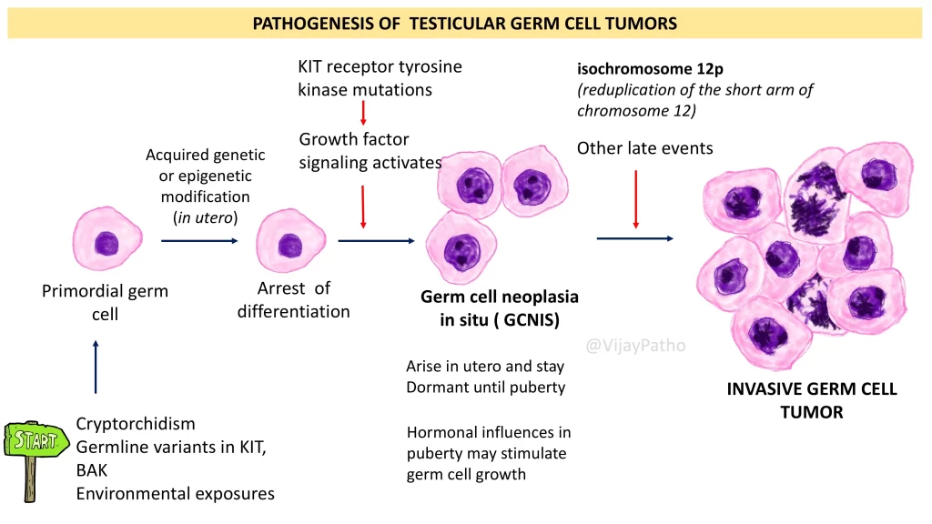 Pathogenesis of germ cell tumors