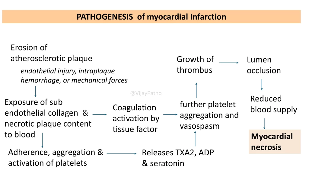 Pathogenesis of myocardial infarction