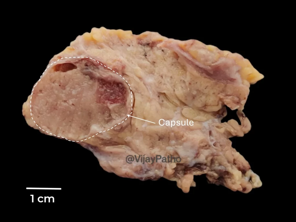 Oncocytoma  gross