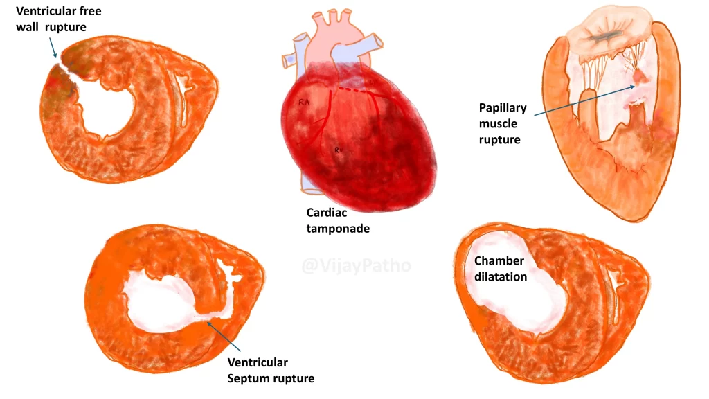 Myocardial infarctions - complications