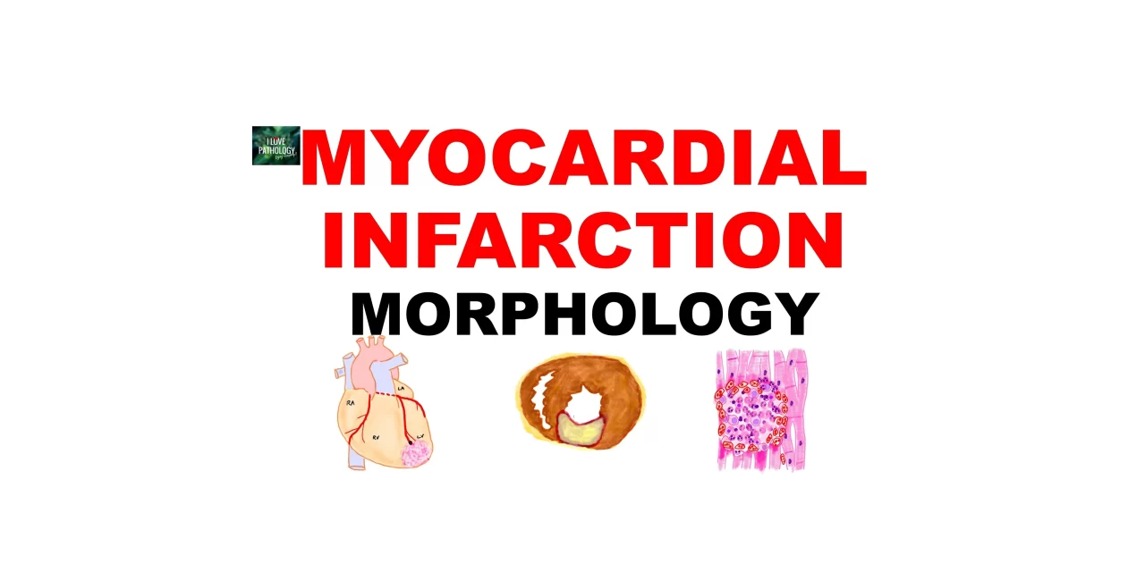 Myocardial Infarction: Gross and Microscopy