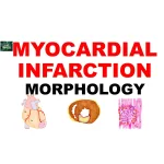 Myocardial infarction morphology