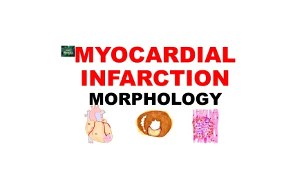 Myocardial Infarction: Gross and Microscopy