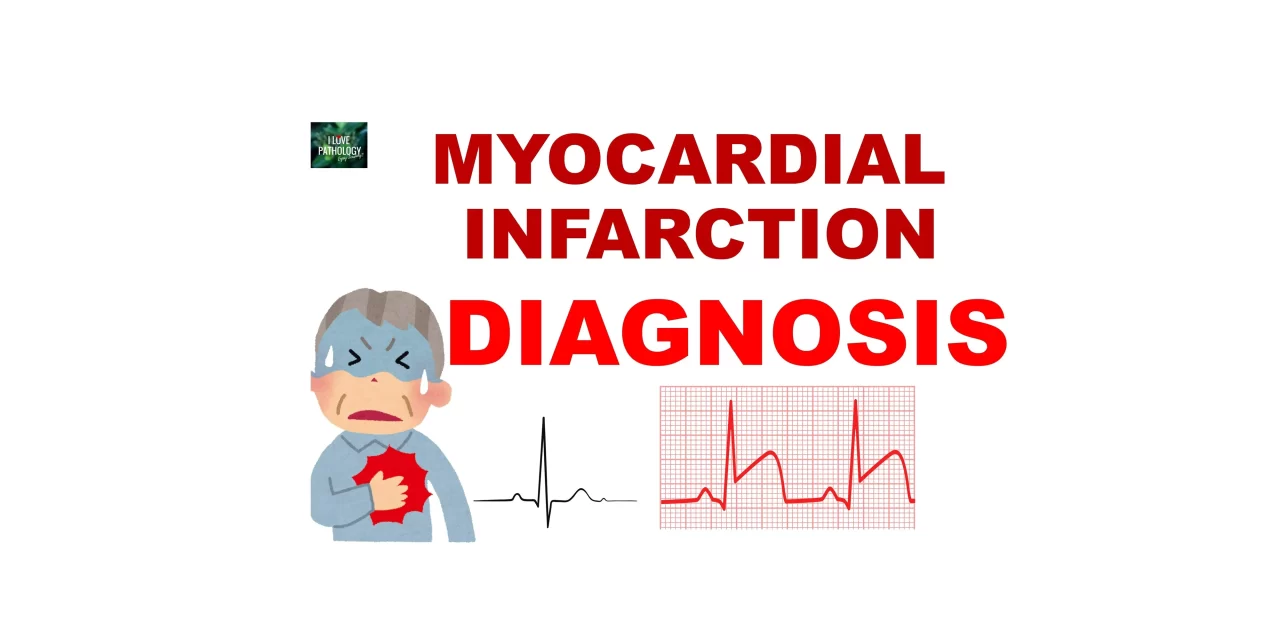 Clinical Features and Diagnosis of Myocardial Infarction