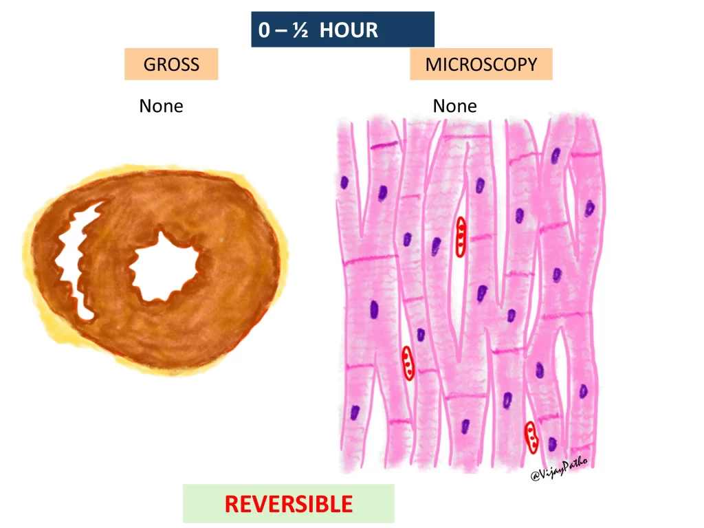 Myocardial infarction - gross and microscopy