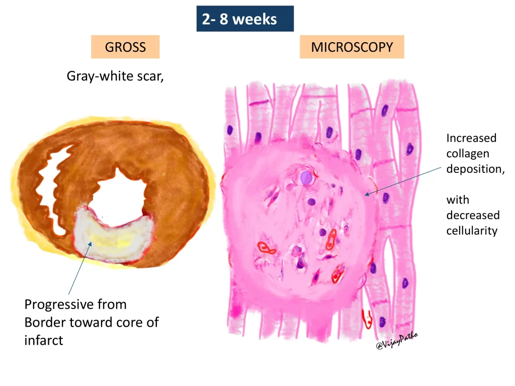 Myocardial infarction - gross and microscopy