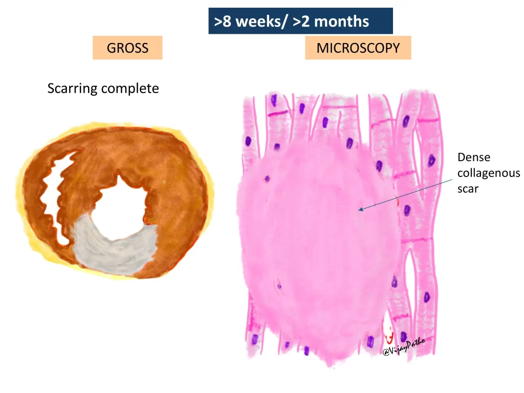 Myocardial infarction - gross and microscopy