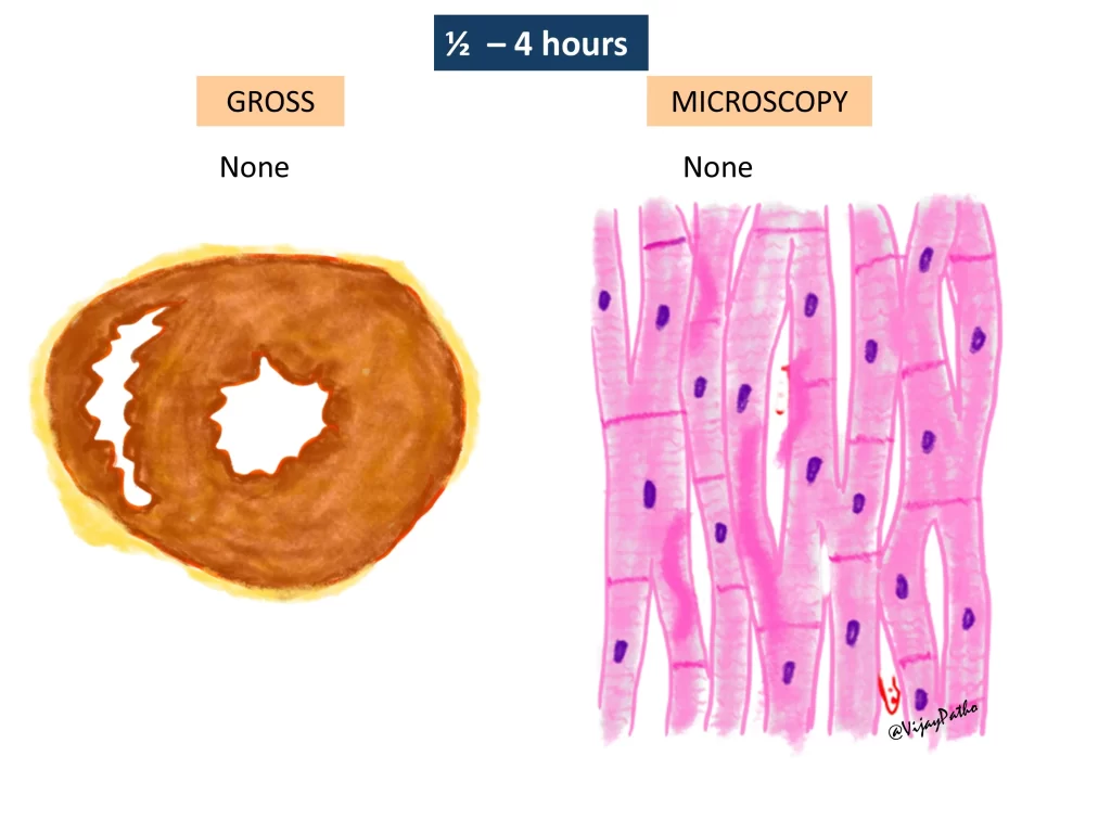 Myocardial infarction - gross and microscopy