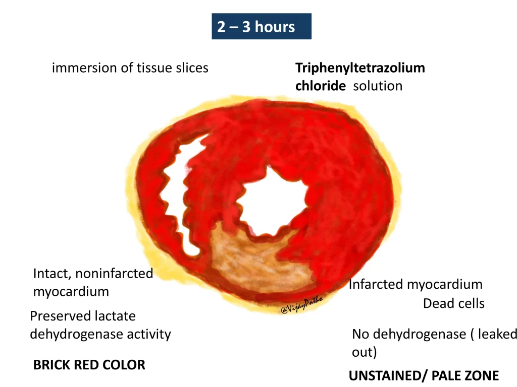 Myocardial infarction - gross and microscopy