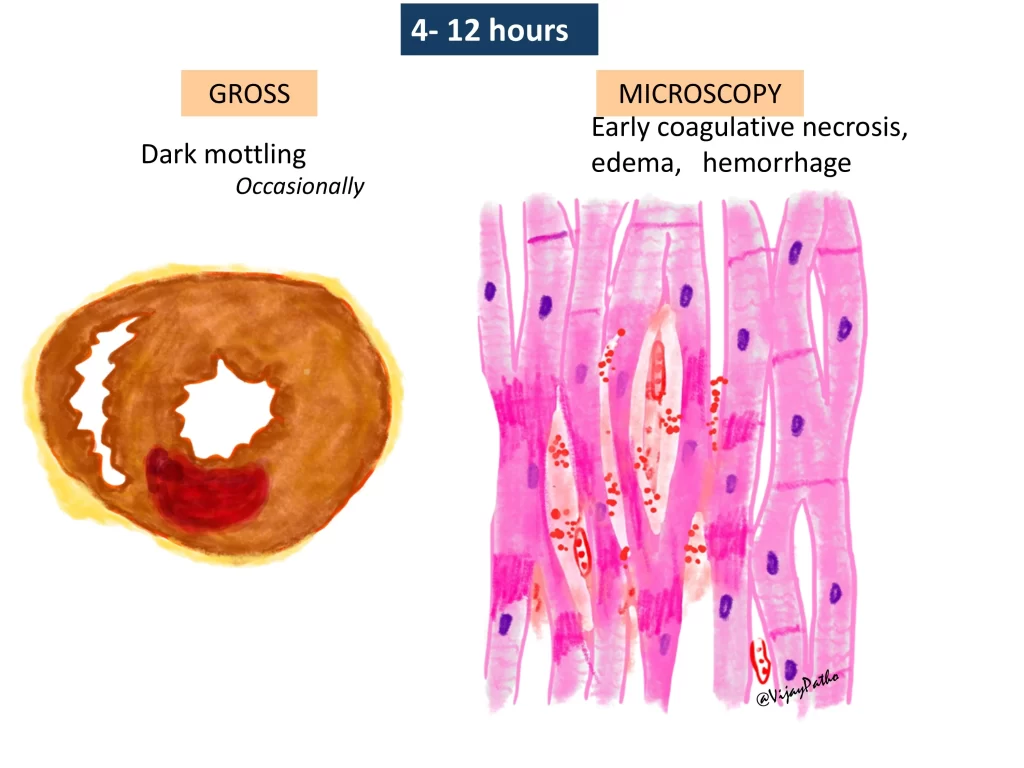 Myocardial infarction - gross and microscopy