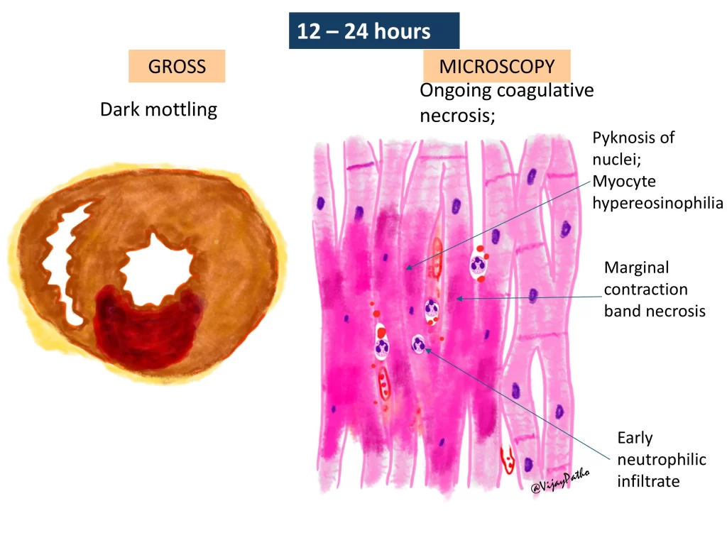 Myocardial infarction - gross and microscopy