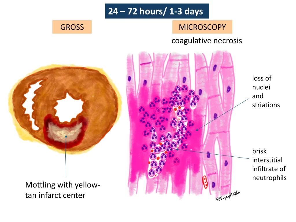 Myocardial infarction - gross and microscopy