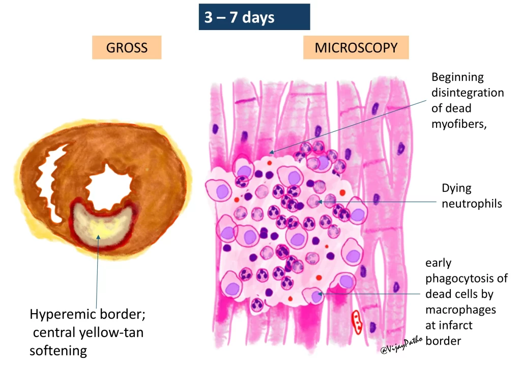 Myocardial infarction - gross and microscopy