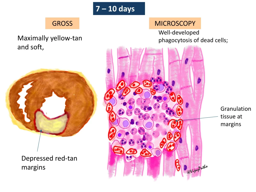 Myocardial infarction - gross and microscopy