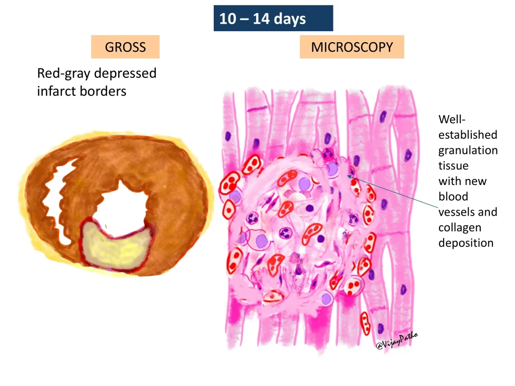 Myocardial infarction - gross and microscopy