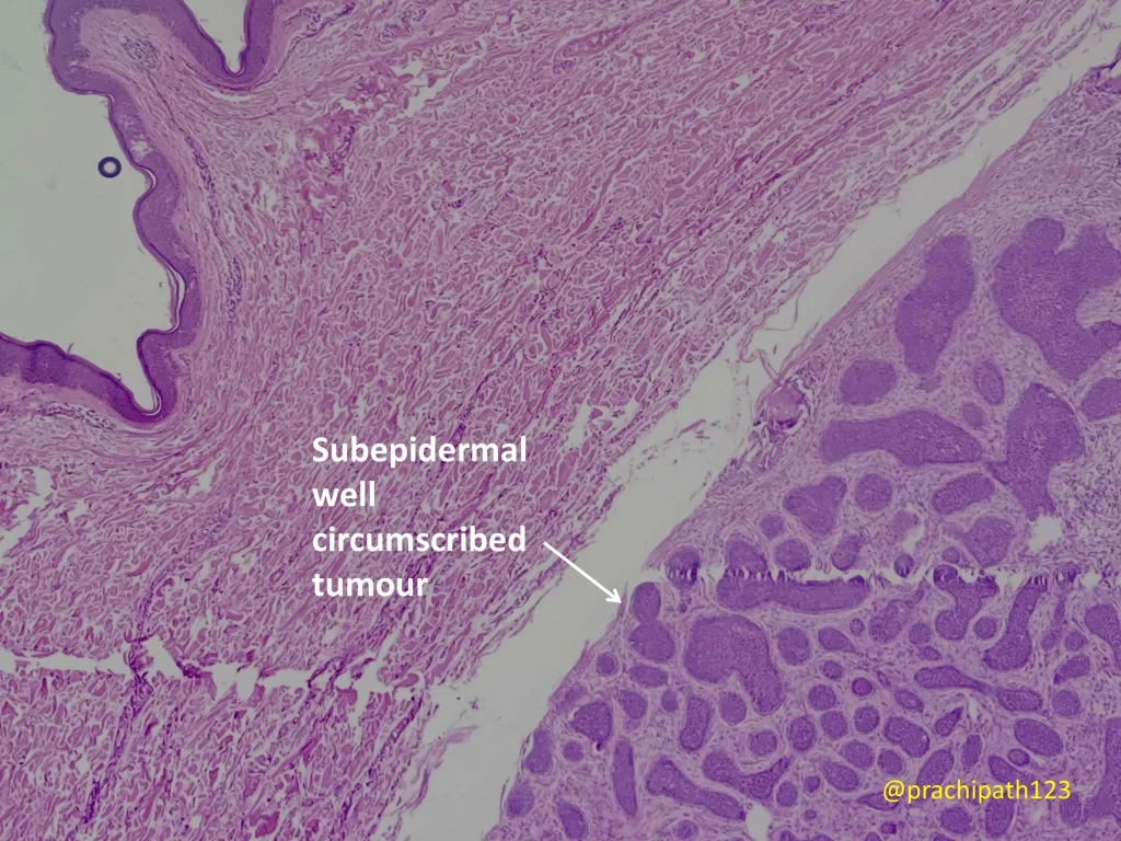 trichoblastoma