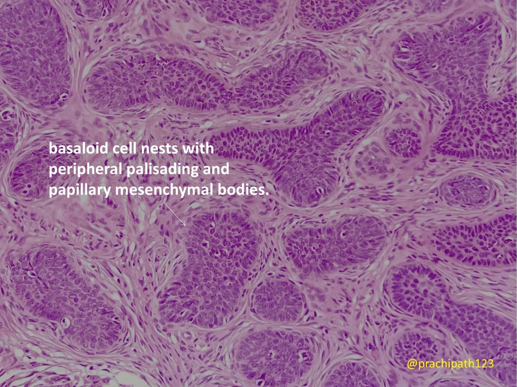 trichoblastoma