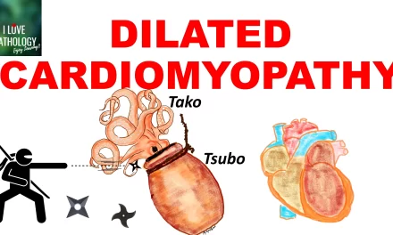 Dilated Cardiomyopathy : Causes, Morphology, Clinical Features, and Treatment
