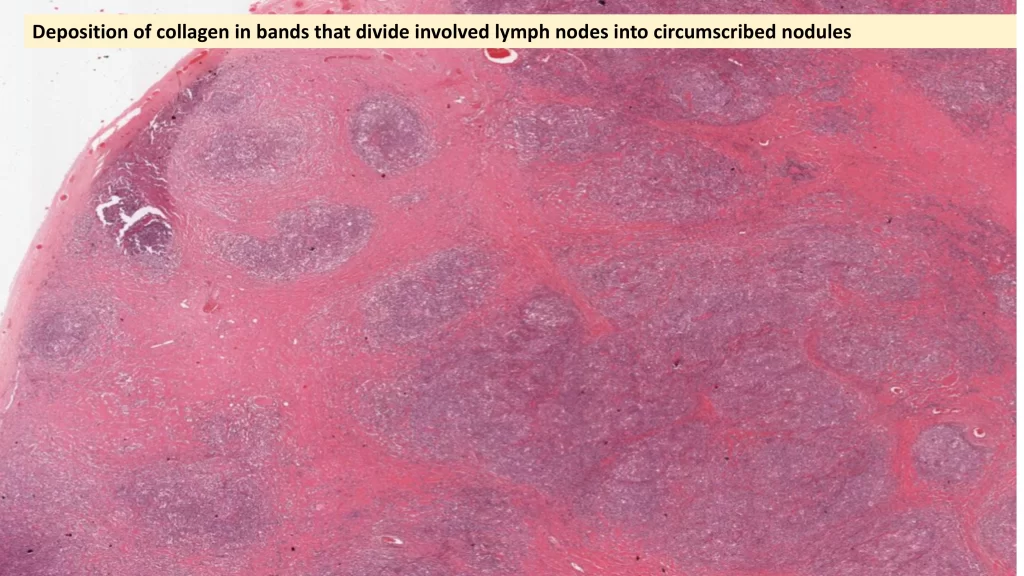 Hodgkin Lymphoma