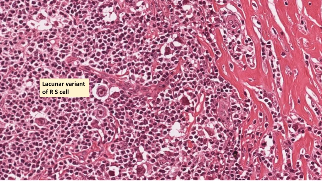 Hodgkin Lymphoma