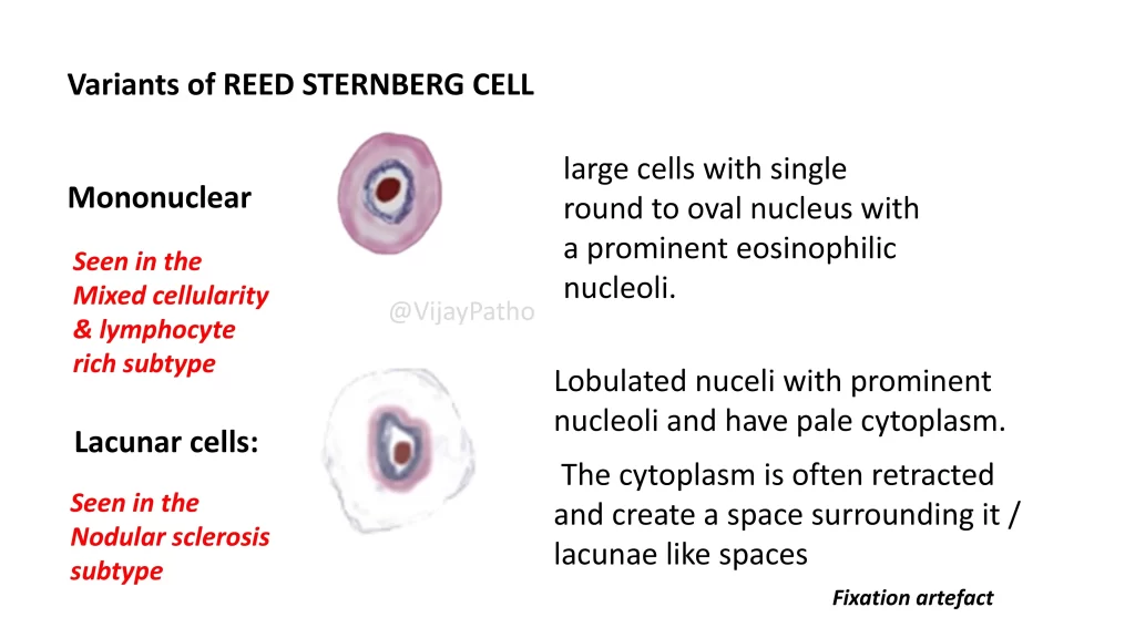 Reed Sternberg Cell