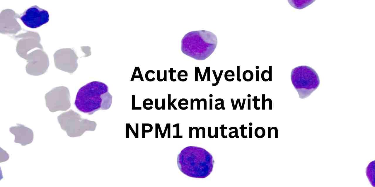 Acute Myeloid Leukemia with NPM1 mutation