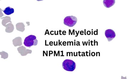 Acute Myeloid Leukemia with NPM1 mutation