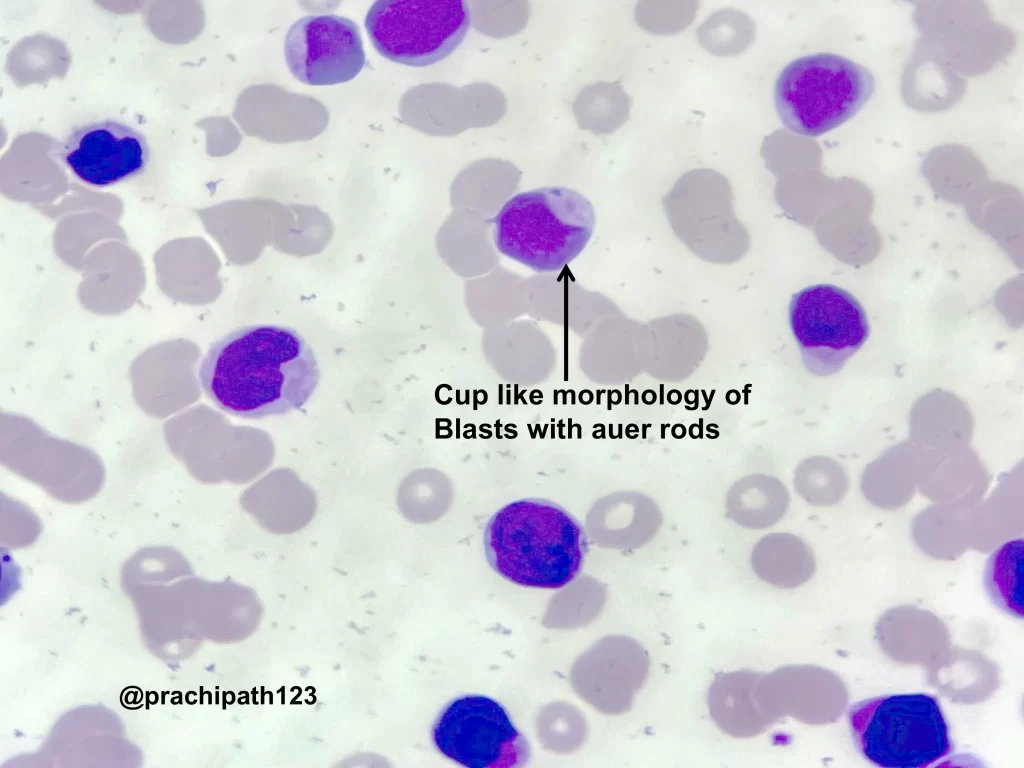 Acute Myeloid Leukemia with NPM1 mutation