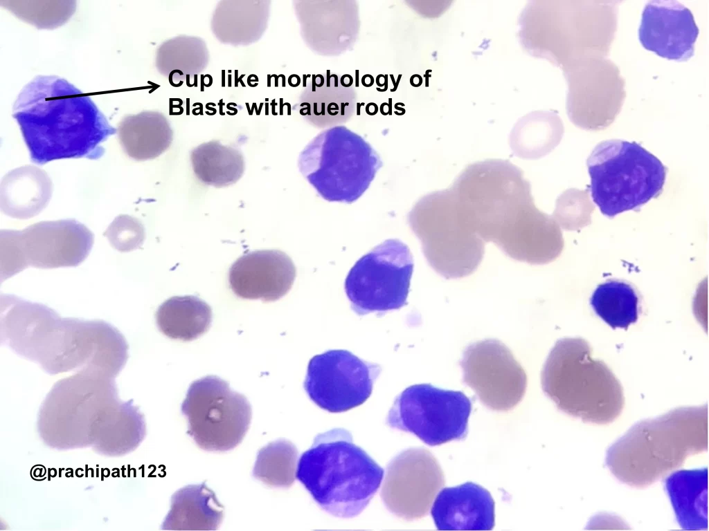 Acute Myeloid Leukemia with NPM1 mutation