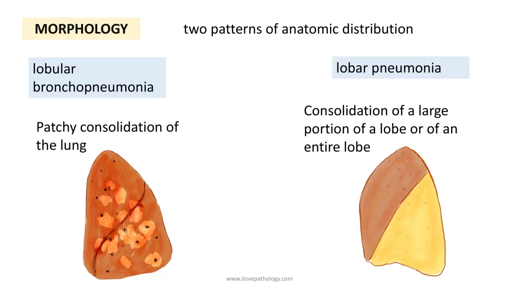 lobar pneumonia
