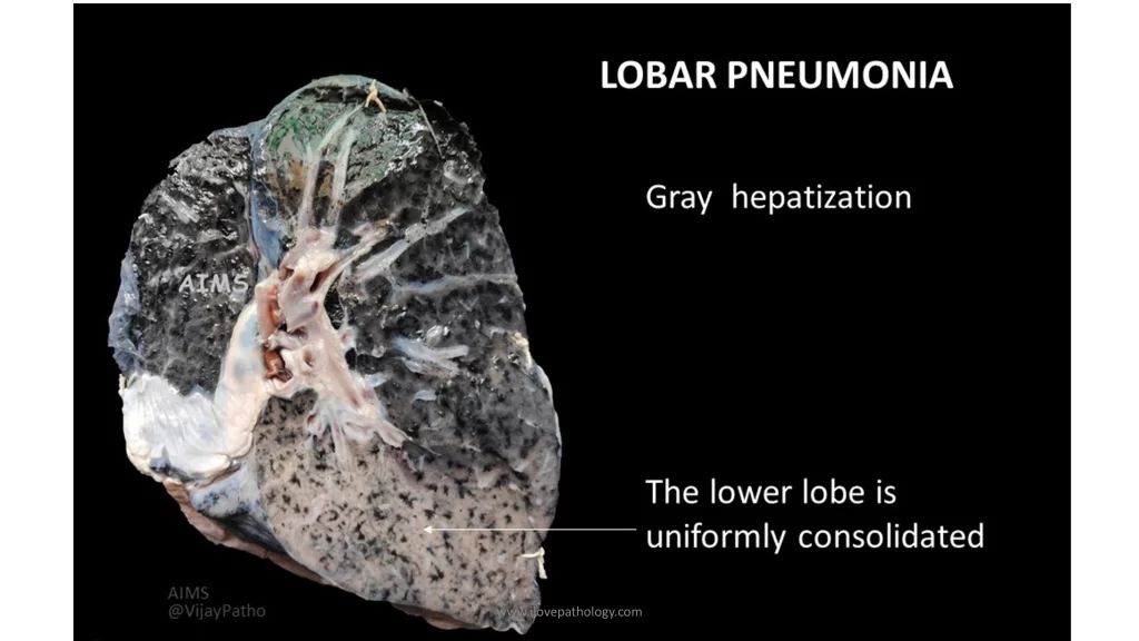 lobar pneumonia