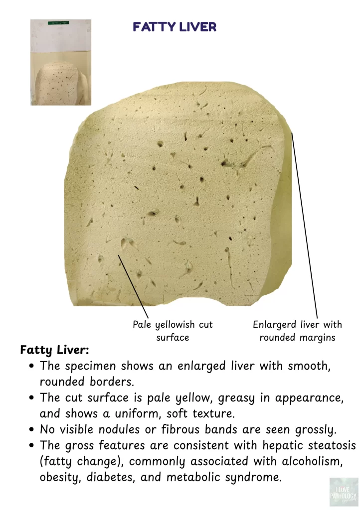 fatty liver