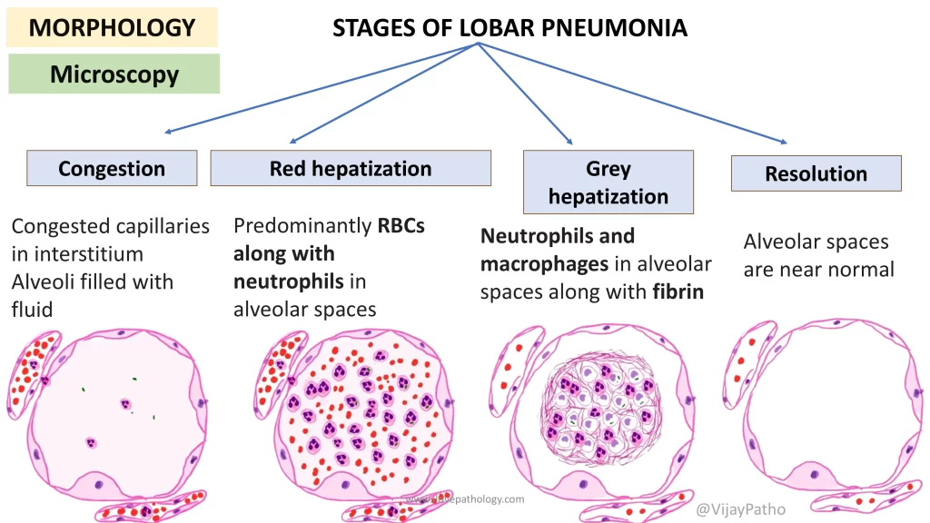 lobar pneumonia