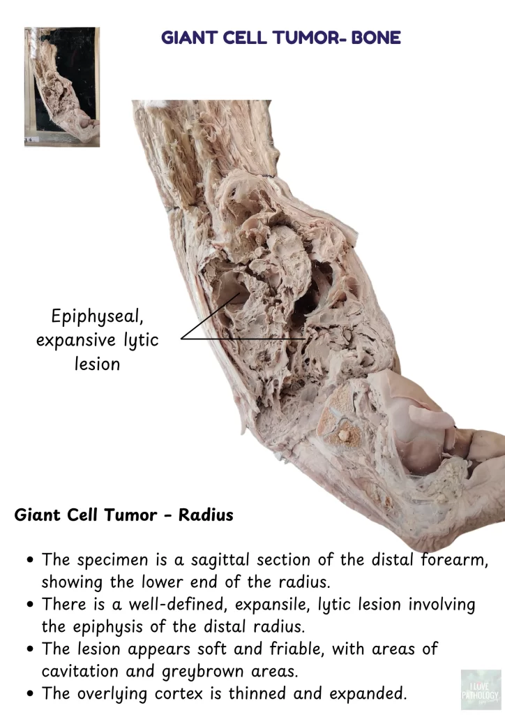 Giant cell tumor - bone