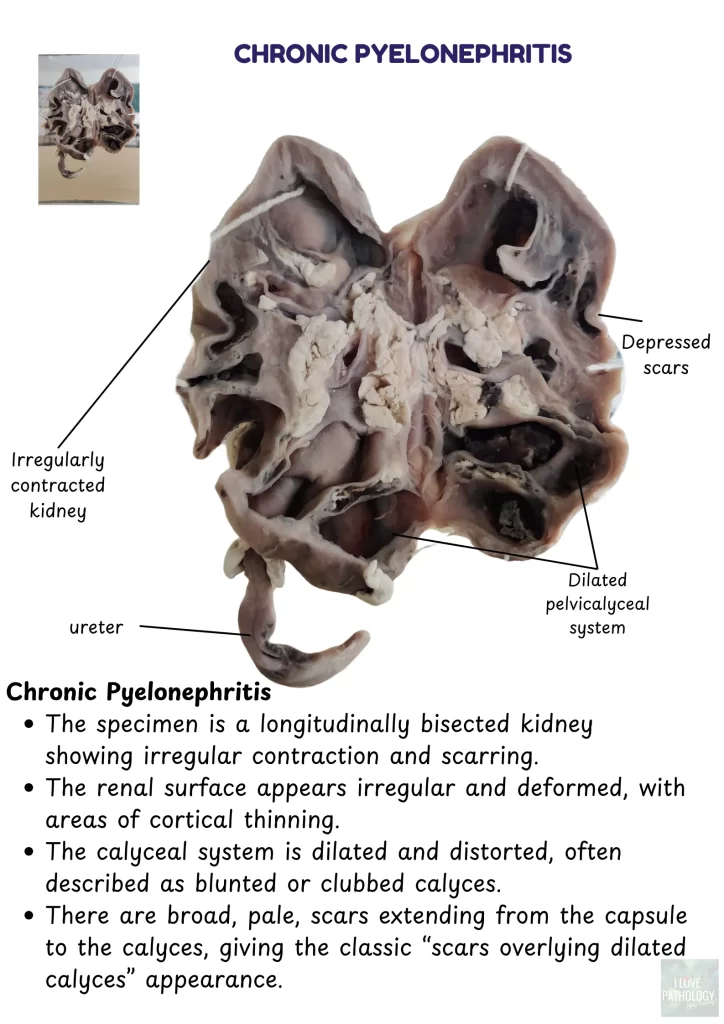 chronic pyelonephritis