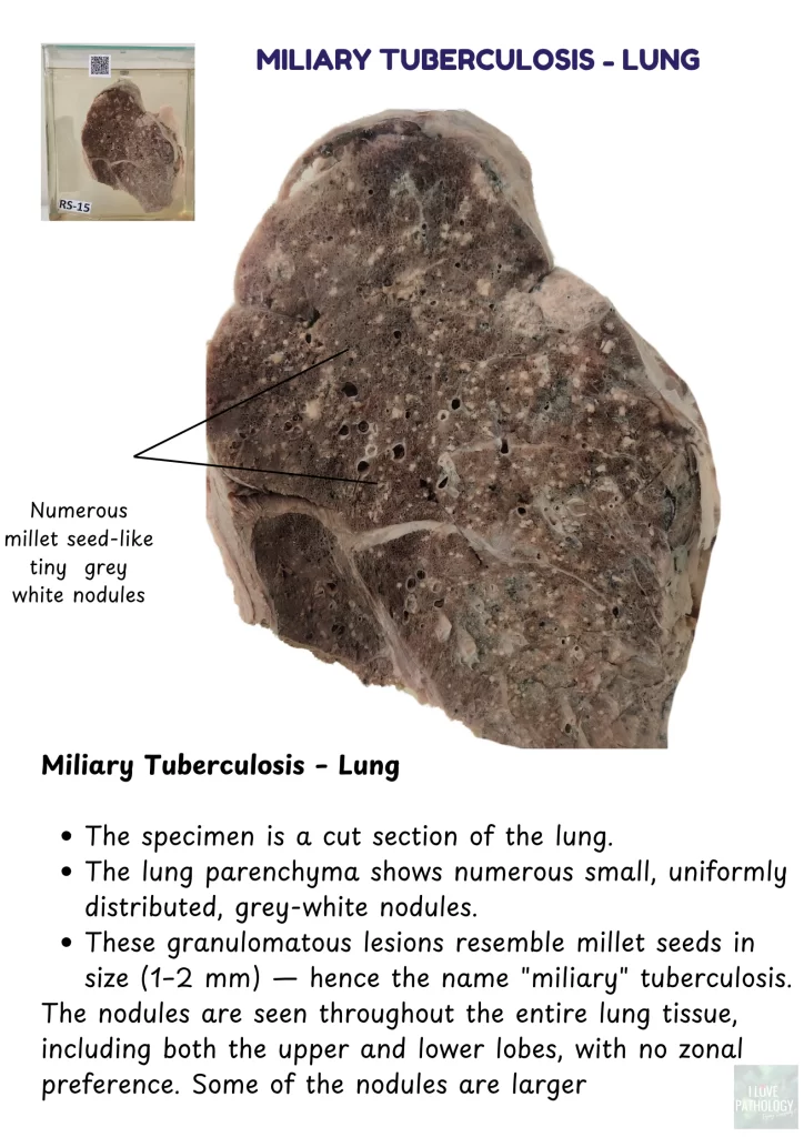 miliary tuberculosis