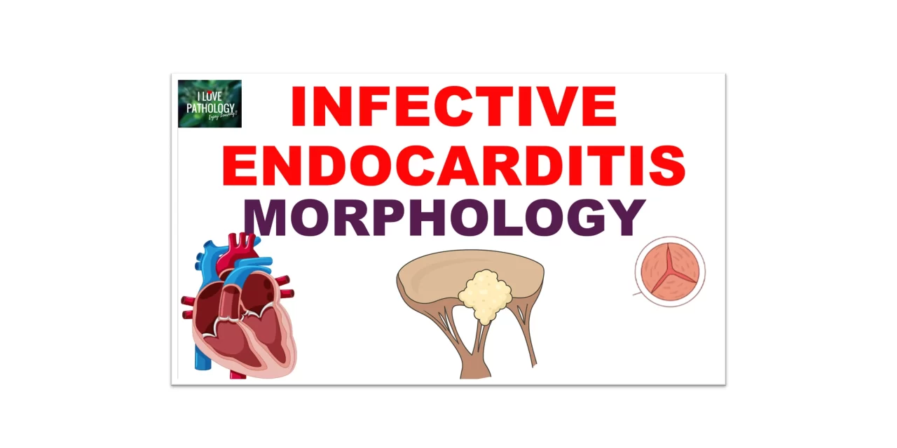 Infective Endocarditis Part 2: Morphology, Clinical Features & Diagnosis