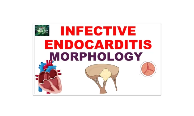 Infective Endocarditis Part 2: Morphology, Clinical Features & Diagnosis