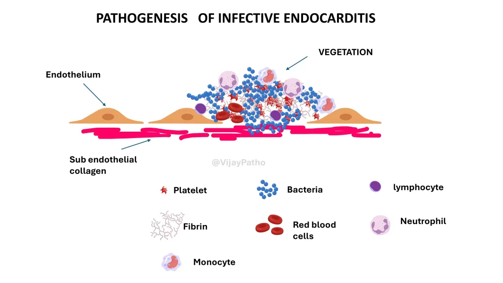 INFECTIVE ENDOCARDITIS 