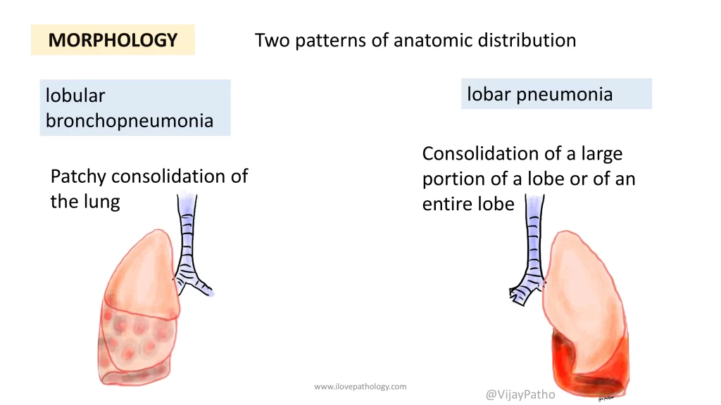 lobar pneumonia