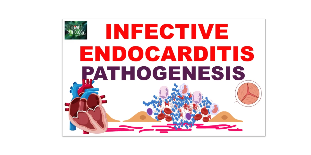 Infective Endocarditis Part 1: Risk Factors and Pathogenesis
