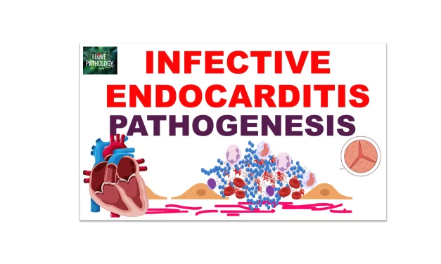 Infective Endocarditis Part 1: Risk Factors and Pathogenesis