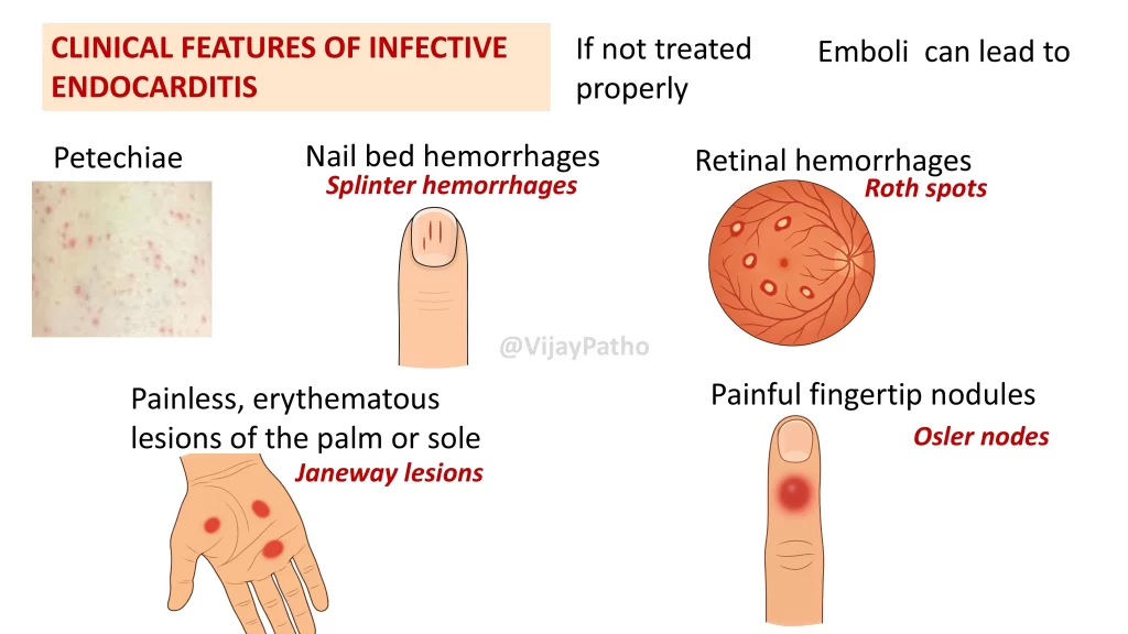INFECTIVE ENDOCARDITIS MORPHOLOGY